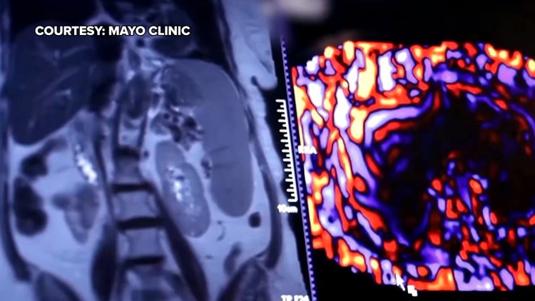 Healthy SA: Battling liver cancer, a disease which often has no symptoms early on — KENS 5 (San Antonio), Grand Forks Health news